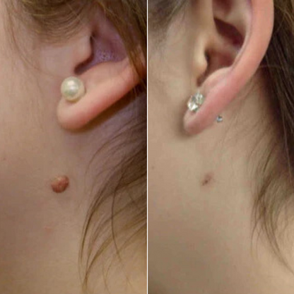 TagPro™ Kit: No More Skin Tags