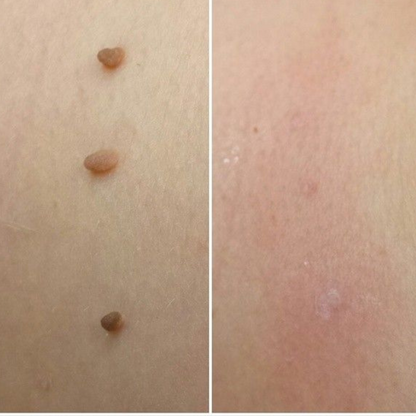 TagPro™ Kit: No More Skin Tags