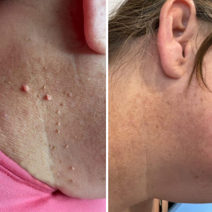 TagPro™ Kit: No More Skin Tags
