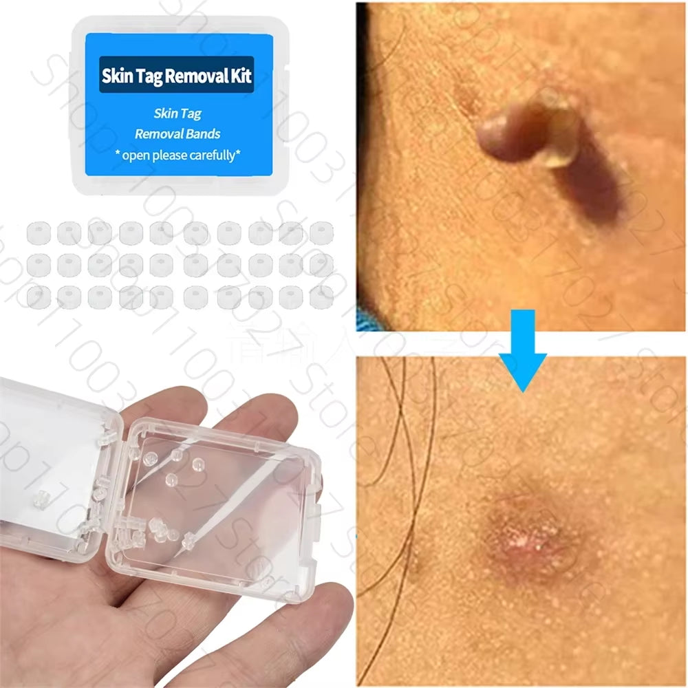 30Pcs/Box Remove Skin Tag Shrink Rubber Ring Non Toxic Health Beauty Skin Care Tools Tag Removal Mole Wart Removal Face Care