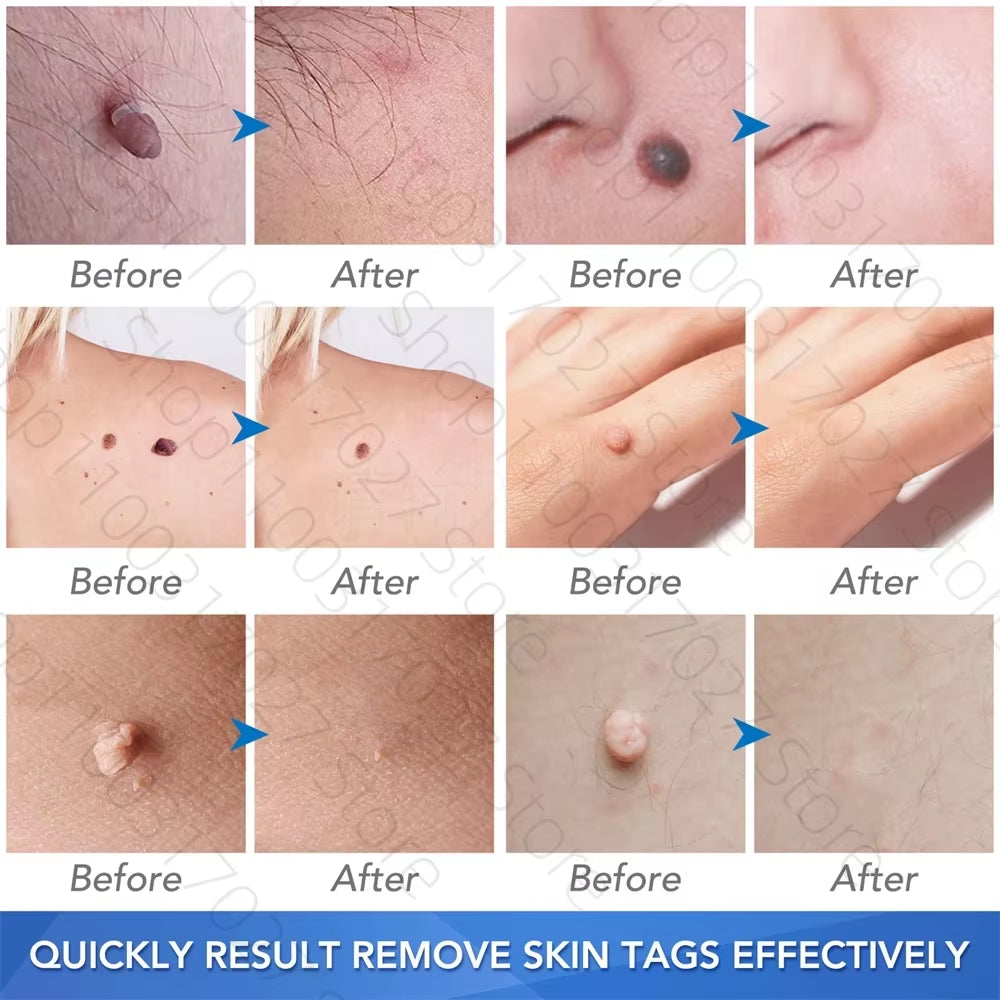 30Pcs/Box Remove Skin Tag Shrink Rubber Ring Non Toxic Health Beauty Skin Care Tools Tag Removal Mole Wart Removal Face Care