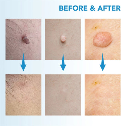 TagPro™ Kit: No More Skin Tags